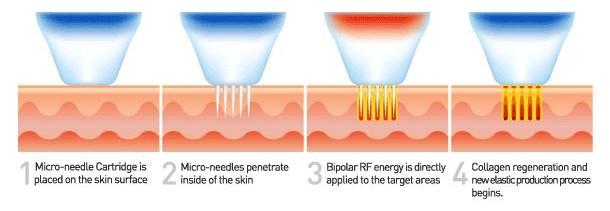 Radio Frequency Micro-Needling Equipment