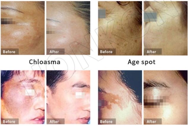 Sanhe Picosure Laser Tattoo Removal ND YAG Laser Machine Sanhe Picosure Laser Tattoo Removal ND YAG Laser Machine
