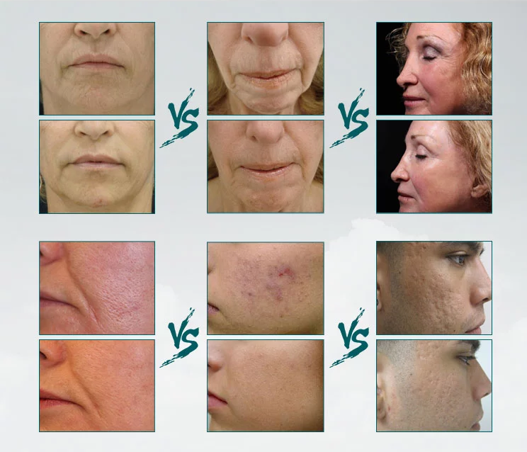 Portable Fractional Rf Face Lift Facial Beauty Machine